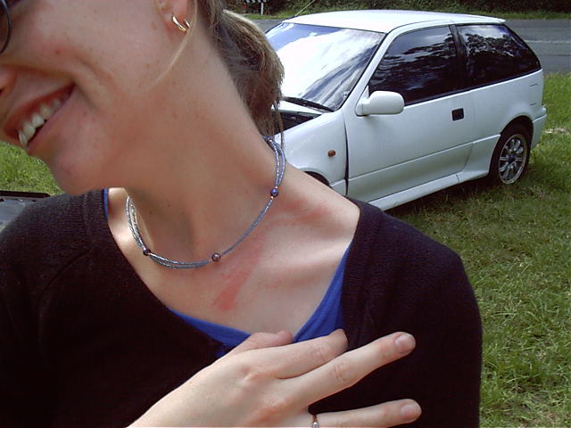 Megan shows off her wounds