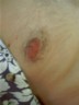 Pat's nipple